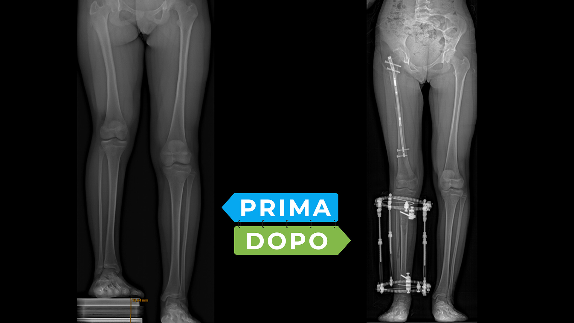 allungamento arti prima e dopo rx allungamento arti prima e dopo rx