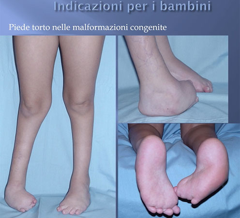 correzione deformita piede Metodo Ilizarov