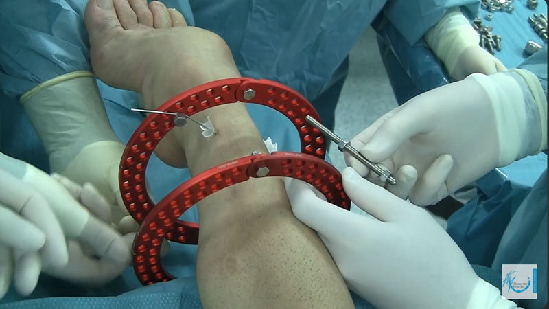 Fissatore Ilizarov Deformita Neurologica Piede