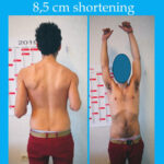 testimonianza allungamento arti omero