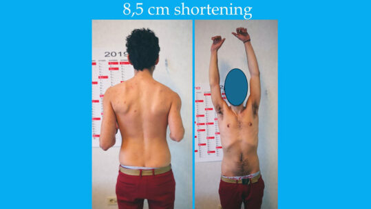 testimonianza allungamento arti omero